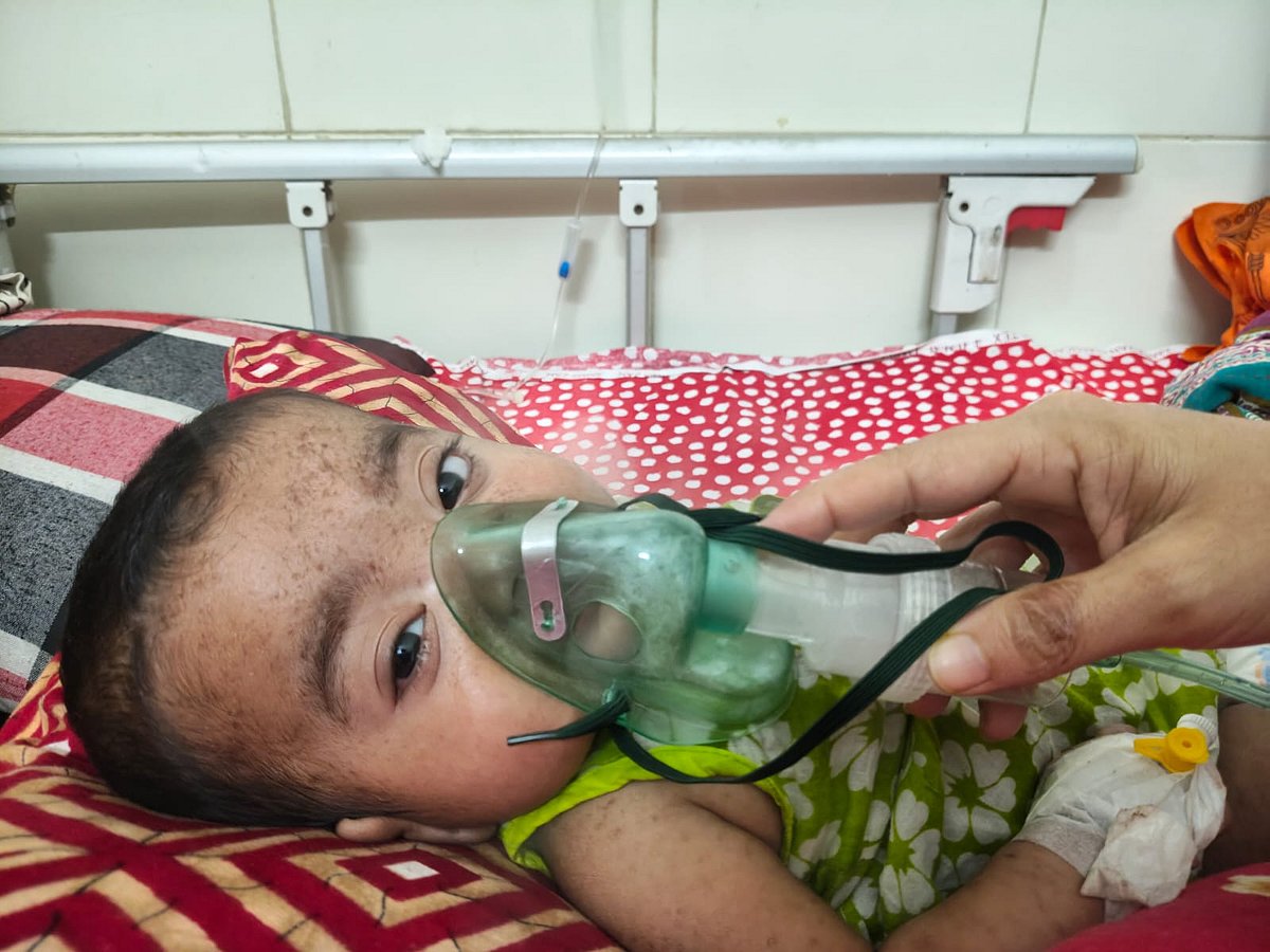 Two more children died with symptoms of measles in Mymensingh Medical