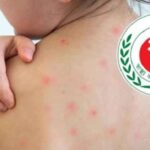 সারাদেশে হাম উপসর্গে আরও ৪ প্রাণহানি