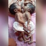 Conjoined Twins Zainab and Umm-e-Kulsum Die at Dhaka Medical College Hospital