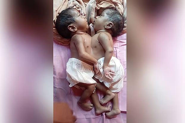Conjoined Twins Zainab and Umm-e-Kulsum Die at Dhaka Medical College Hospital