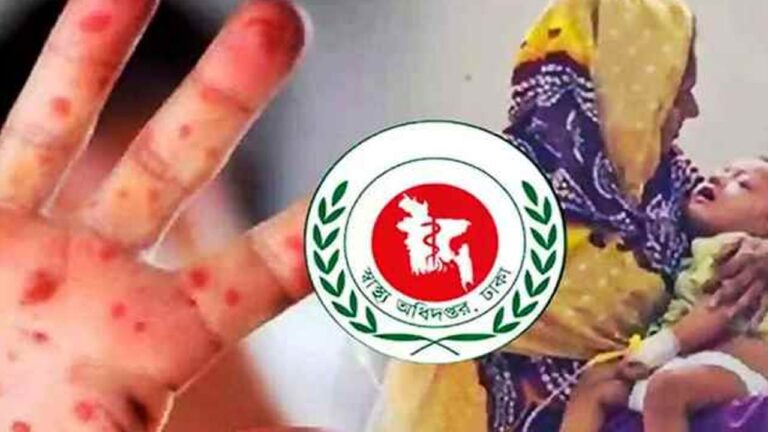 সিলেটে হামে আরও এক শিশুর মৃত্যু চিকিৎসাধীন ৩১৭ জন