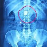 Hospital Patient Recovers Stolen Gold Chains After Thief Swallows Them in Noakhali
