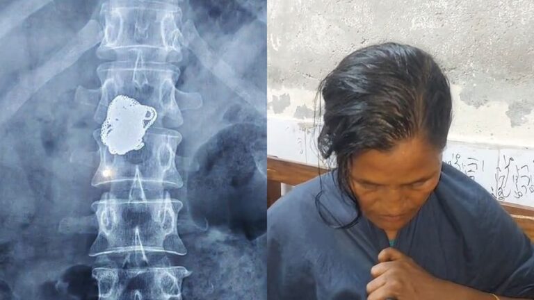 নোয়াখালীতে রোগী সেজে চুরির পর গিলে ফেলা স্বর্ণের চেইন পেট থেকে উদ্ধার